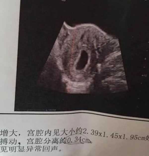 广州卵巢早衰试管_拒绝怀孕切除子宫_试管婴儿移植28天后b超显示一12x10㎜大小
